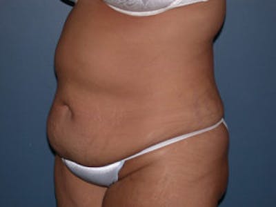 Tummy Tuck (Abdominoplasty) Before & After Gallery - Patient 4594890 - Image 1