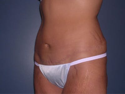 Tummy Tuck (Abdominoplasty) Before & After Gallery - Patient 4594890 - Image 2
