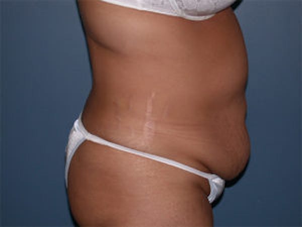 Tummy Tuck (Abdominoplasty) Before & After Gallery - Patient 4594890 - Image 3