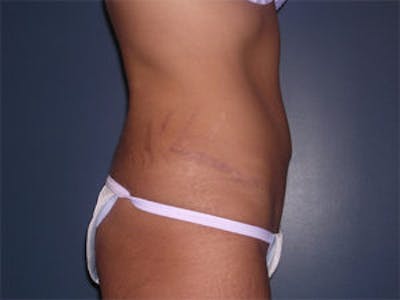Tummy Tuck (Abdominoplasty) Gallery - Patient 4594890 - Image 4