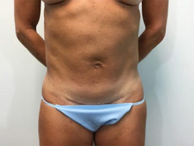 Tummy Tuck (Abdominoplasty) Before & After Gallery - Patient 4594891 - Image 2