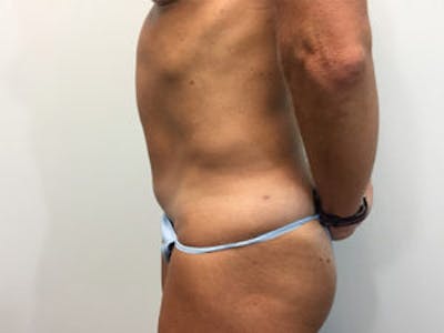 Tummy Tuck (Abdominoplasty) Before & After Gallery - Patient 4594891 - Image 4