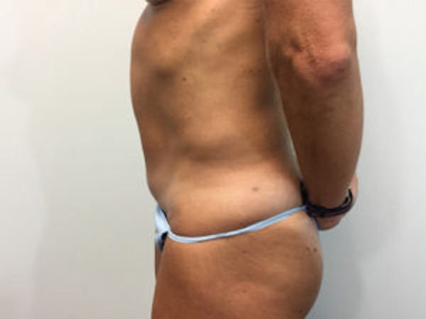 Tummy Tuck (Abdominoplasty) Before & After Gallery - Patient 4594891 - Image 4