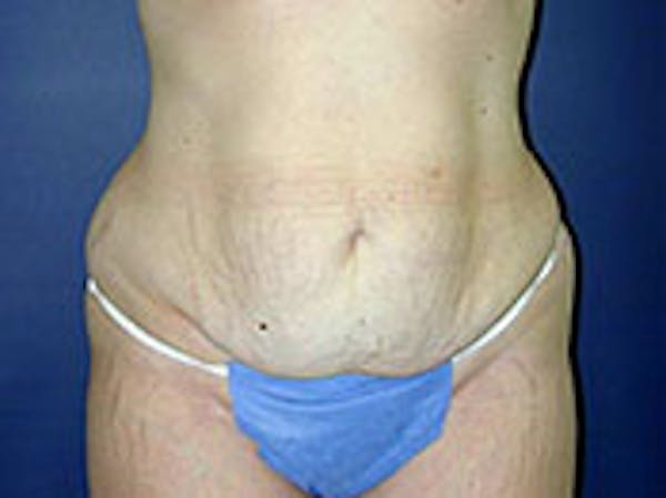 Tummy Tuck (Abdominoplasty) Before & After Gallery - Patient 4594892 - Image 1