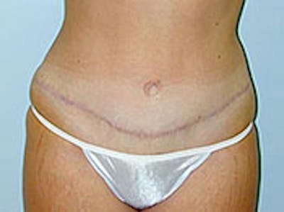 Tummy Tuck (Abdominoplasty) Before & After Gallery - Patient 4594892 - Image 2