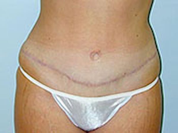 Tummy Tuck (Abdominoplasty) Before & After Gallery - Patient 4594892 - Image 2