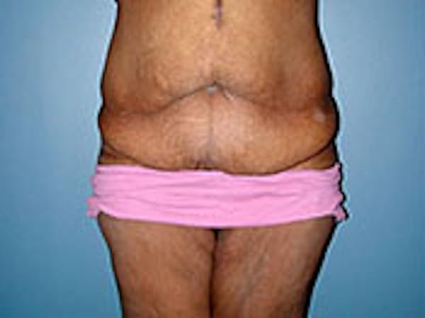 Tummy Tuck (Abdominoplasty) Before & After Gallery - Patient 4594893 - Image 1