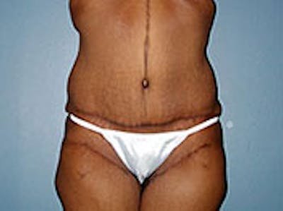 Tummy Tuck (Abdominoplasty) Before & After Gallery - Patient 4594893 - Image 2