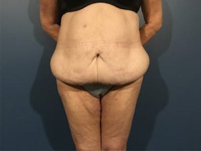 Tummy Tuck (Abdominoplasty) Before & After Gallery - Patient 4594894 - Image 1