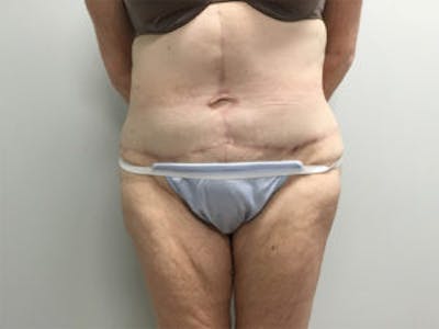 Tummy Tuck (Abdominoplasty) Before & After Gallery - Patient 4594894 - Image 2