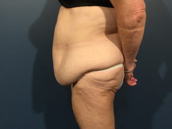 Tummy Tuck (Abdominoplasty) Before & After Gallery - Patient 4594894 - Image 3