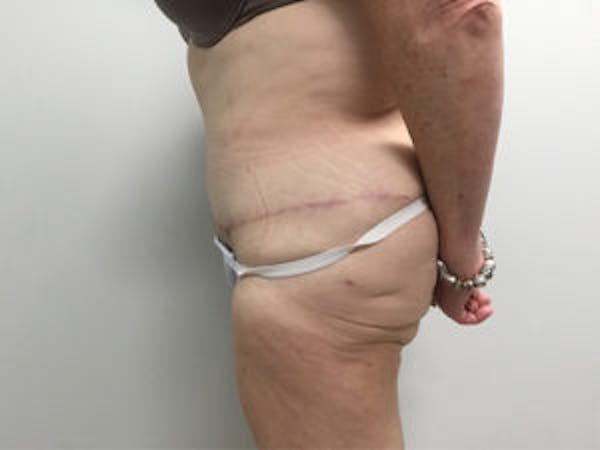 Tummy Tuck (Abdominoplasty) Before & After Gallery - Patient 4594894 - Image 4