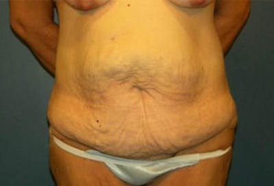 Tummy Tuck (Abdominoplasty) Before & After Gallery - Patient 4594896 - Image 1