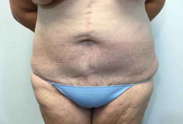 Tummy Tuck (Abdominoplasty) Before & After Gallery - Patient 4594896 - Image 2