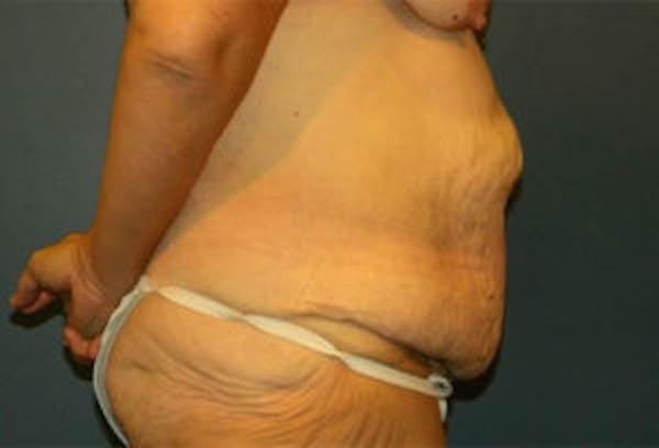 Tummy Tuck (Abdominoplasty) Before & After Gallery - Patient 4594896 - Image 3