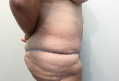 Tummy Tuck (Abdominoplasty) Before & After Gallery - Patient 4594896 - Image 4