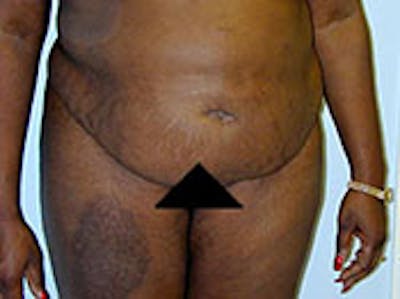 Tummy Tuck (Abdominoplasty) Before & After Gallery - Patient 4594897 - Image 1