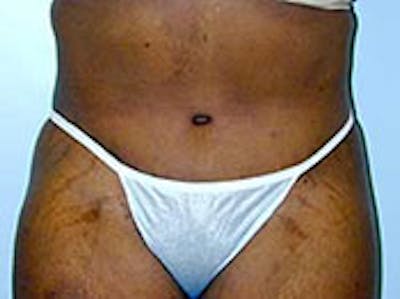 Tummy Tuck (Abdominoplasty) Gallery - Patient 4594897 - Image 2