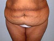 Tummy Tuck in Richmond Before & After Photos