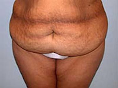 Tummy Tuck (Abdominoplasty) Before & After Gallery - Patient 4594898 - Image 1