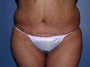 Tummy Tuck in Richmond Before & After Photos