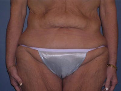 Tummy Tuck (Abdominoplasty) Before & After Gallery - Patient 4594899 - Image 1