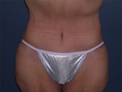 Tummy Tuck (Abdominoplasty) Before & After Gallery - Patient 4594899 - Image 2