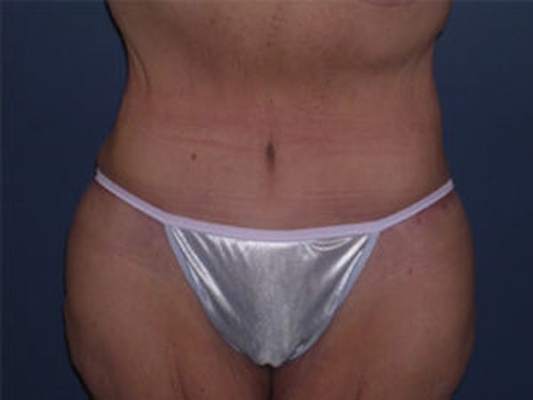 Tummy Tuck (Abdominoplasty) Before & After Gallery - Patient 4594899 - Image 2