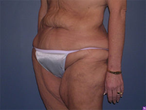 Tummy Tuck (Abdominoplasty) Before & After Gallery - Patient 4594899 - Image 3