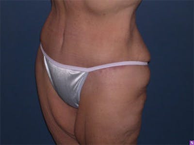 Tummy Tuck (Abdominoplasty) Gallery - Patient 4594899 - Image 4