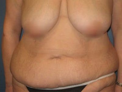 Tummy Tuck (Abdominoplasty) Before & After Gallery - Patient 4594900 - Image 1