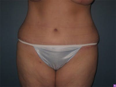 Tummy Tuck (Abdominoplasty) Before & After Gallery - Patient 4594900 - Image 2