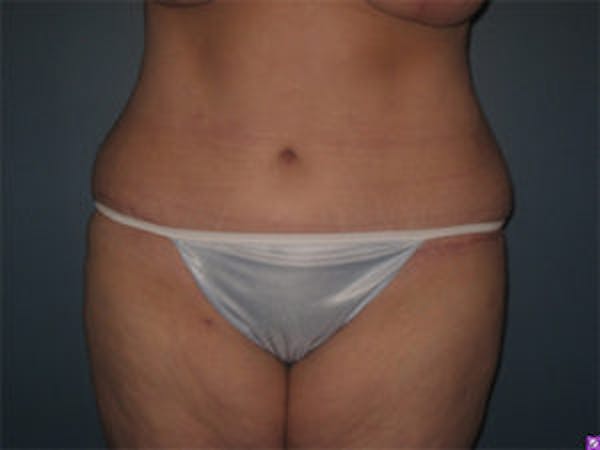 Tummy Tuck (Abdominoplasty) Before & After Gallery - Patient 4594900 - Image 2