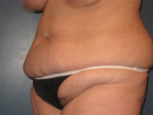 Tummy Tuck (Abdominoplasty) Before & After Gallery - Patient 4594900 - Image 3