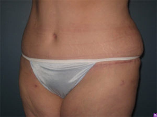 Tummy Tuck (Abdominoplasty) Before & After Gallery - Patient 4594900 - Image 4