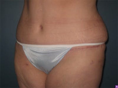 Tummy Tuck (Abdominoplasty) Gallery - Patient 4594900 - Image 4