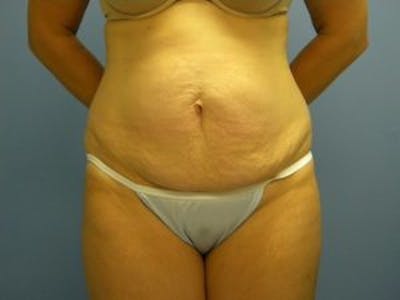Tummy Tuck (Abdominoplasty) Before & After Gallery - Patient 4594901 - Image 1