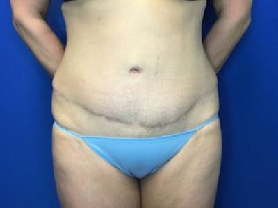 Tummy Tuck (Abdominoplasty) Before & After Gallery - Patient 4594901 - Image 2