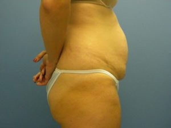 Tummy Tuck (Abdominoplasty) Before & After Gallery - Patient 4594901 - Image 3