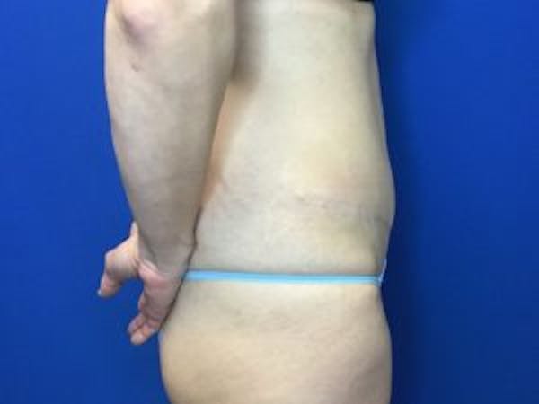 Tummy Tuck (Abdominoplasty) Before & After Gallery - Patient 4594901 - Image 4