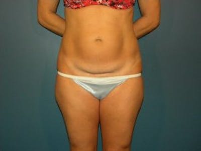 Tummy Tuck (Abdominoplasty) Before & After Gallery - Patient 4594902 - Image 1
