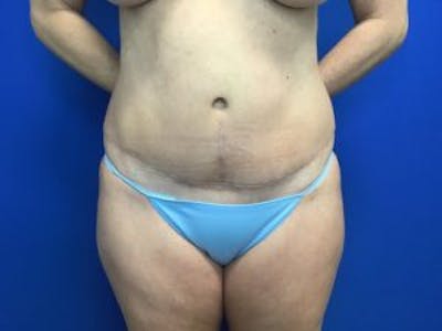 Tummy Tuck (Abdominoplasty) Before & After Gallery - Patient 4594902 - Image 2