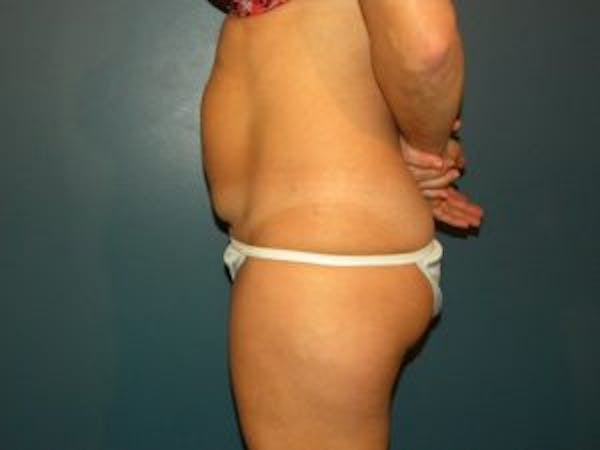 Tummy Tuck (Abdominoplasty) Before & After Gallery - Patient 4594902 - Image 3