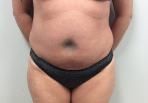Tummy Tuck (Abdominoplasty) Before & After Gallery - Patient 4594903 - Image 1