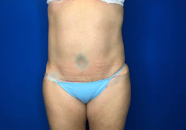 Tummy Tuck (Abdominoplasty) Before & After Gallery - Patient 4594903 - Image 2