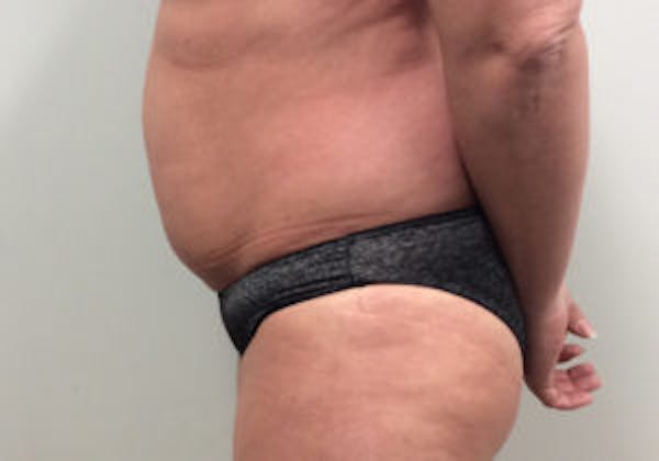 Tummy Tuck (Abdominoplasty) Before & After Gallery - Patient 4594903 - Image 3