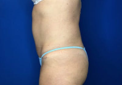 Tummy Tuck (Abdominoplasty) Gallery - Patient 4594903 - Image 4