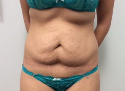 Tummy Tuck (Abdominoplasty) Before & After Gallery - Patient 4594904 - Image 1