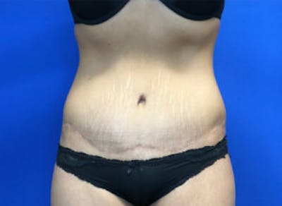 Tummy Tuck (Abdominoplasty) Before & After Gallery - Patient 4594904 - Image 2
