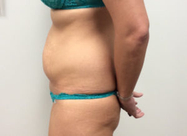 Tummy Tuck (Abdominoplasty) Before & After Gallery - Patient 4594904 - Image 3